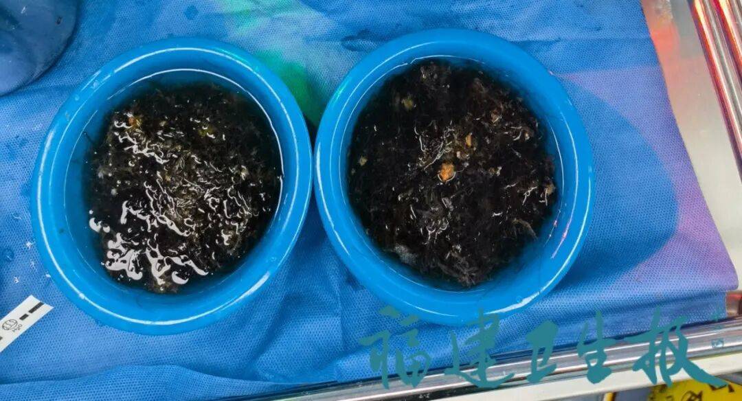 发现一例，10岁女孩确诊！已有多起病例，有人因羞耻感延误就医