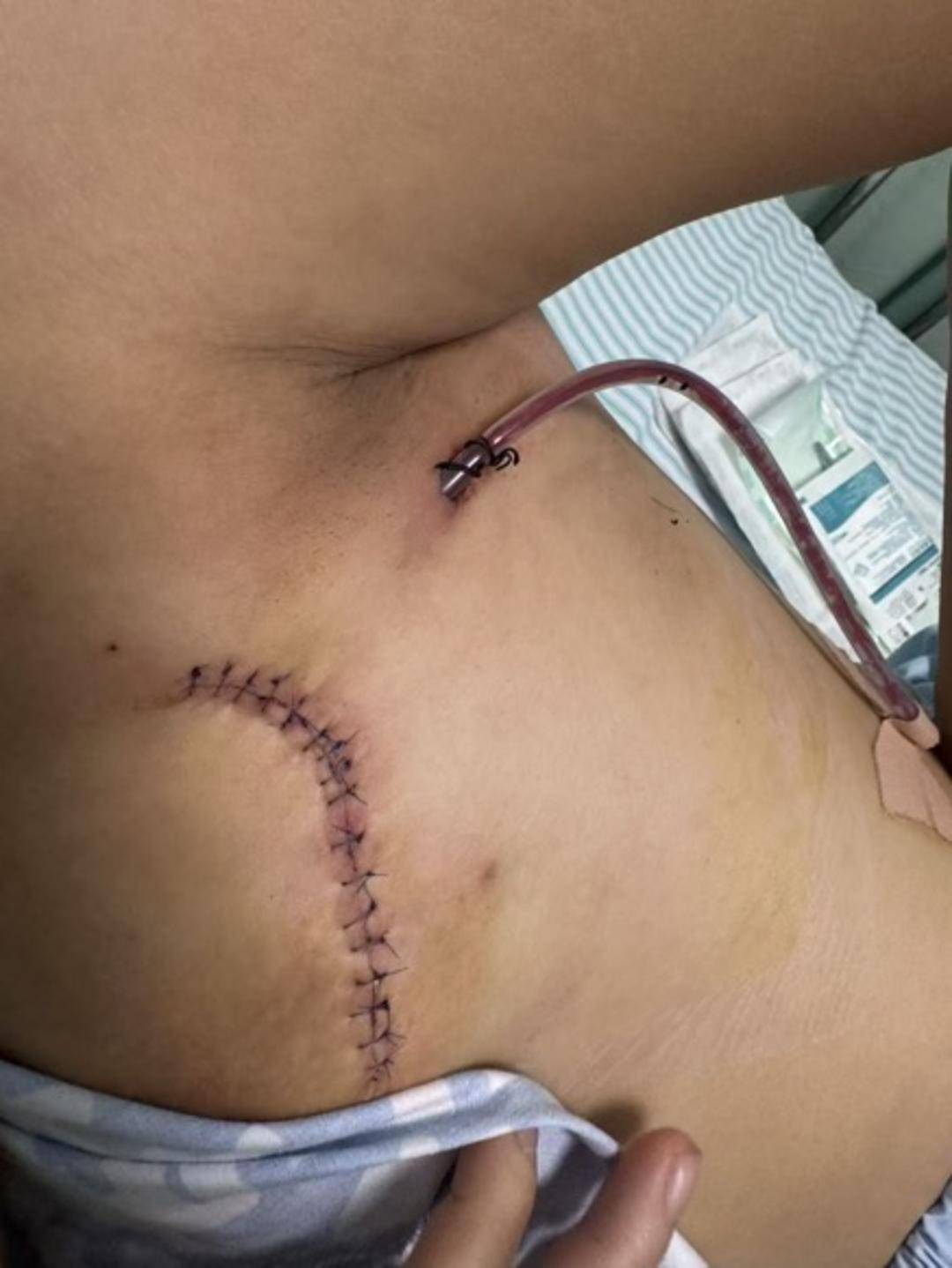 "相当于是切除了左胸五分之二,伤口缝了17针