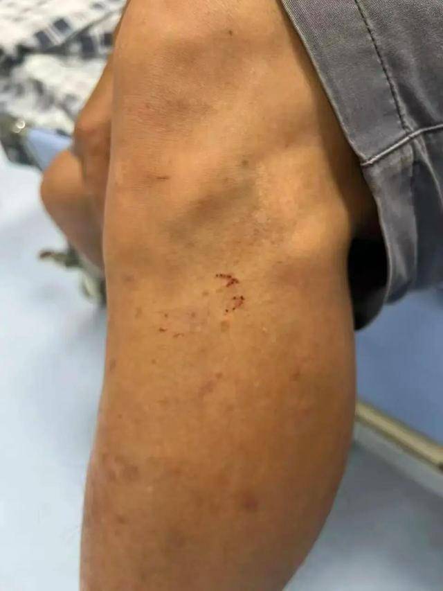 广东62岁阿叔网鱼网到2条眼镜蛇，被咬伤后当场打死，并打包提进医院