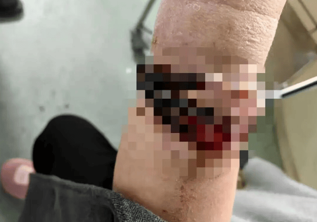 女子手镯10年没摘竟“长”进肉里!医生:再晚点可能危及生命