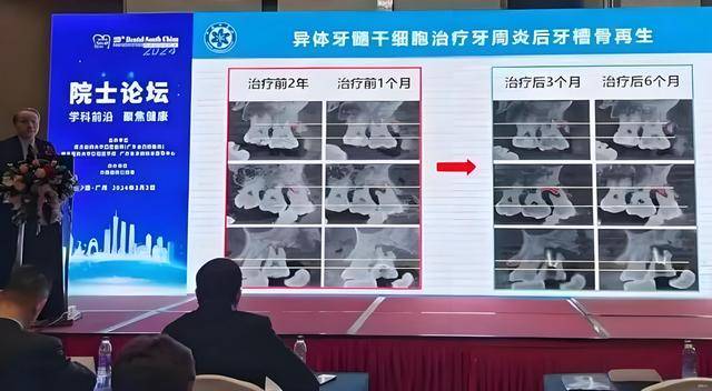 海南再立大功！一针干细胞彻底告别牙周炎5万让牙齿无痛再生