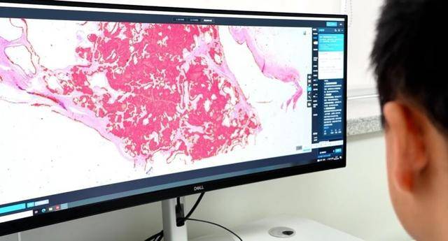 新口腔病理学 全球首个临床级多模态口腔病理大模型成都“上岗”_搜狐网