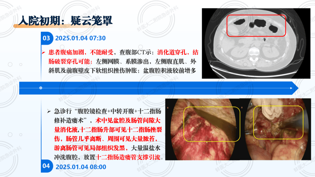 一例创伤性十二指肠破裂患者的案例分享