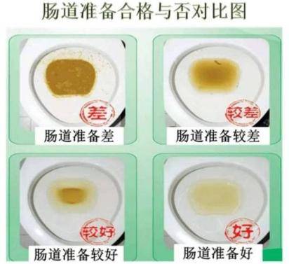 别害羞，聊聊做肠镜前的那件“大事”