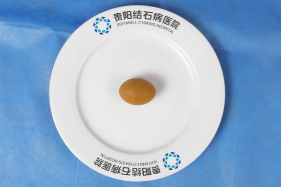 蜜蜡状胆囊结石现身贵阳，专家呼吁有这些习惯要警惕