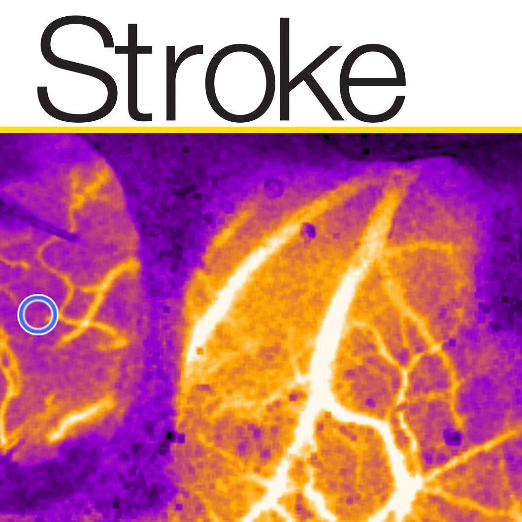 期刊精华|Stroke 12月刊:替奈普酶于大血管闭塞、儿童烟雾病手术时机、穿支动脉区梗死预后、PCISOS风险分层模型、失用症预测卒中恢复 ...