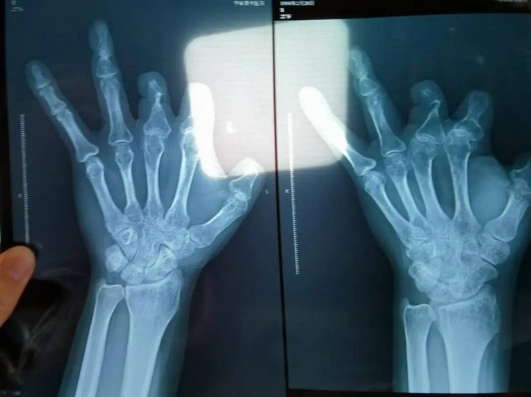 单价1.68万元器材植入体内后“消失”，郑大一附院医生诈骗94名患者获刑：4年间收回扣105万余元