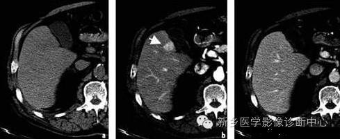 肝脏富血供病变，应想到这16种疾病