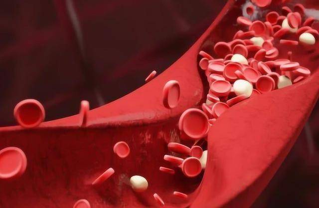 85%的血管淤堵，根本不用过度治疗！医生：做好3件事，比吃药管用