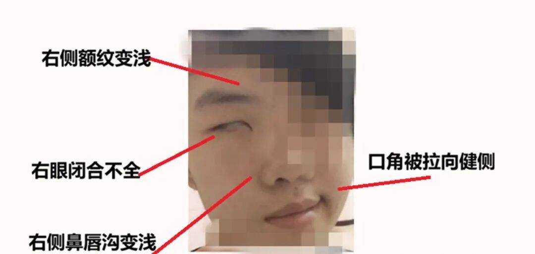 假期疯玩数日, 19岁小伙一夜变“面瘫”！近期高发！紧急提醒：剧痛且凶险，千万别硬杠_小齐_面神经_面部