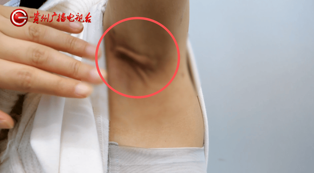 贵阳女子花7500元祛狐臭 翡丽斯整形术后腋下出现5厘米疤痕(图11)